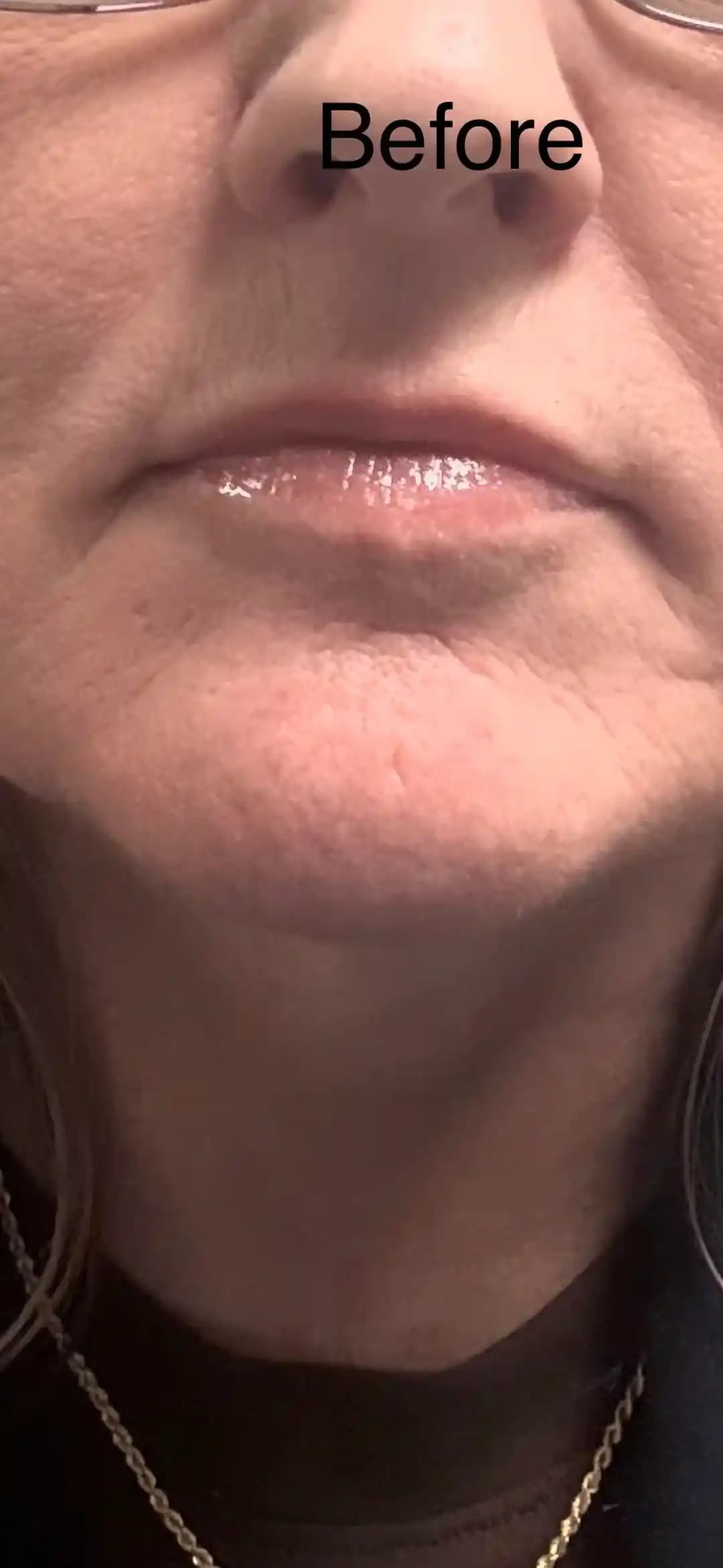 TCA Peeling Sonrası Ciltteki Değişiklikler ve Doğru Bakım Önerileri