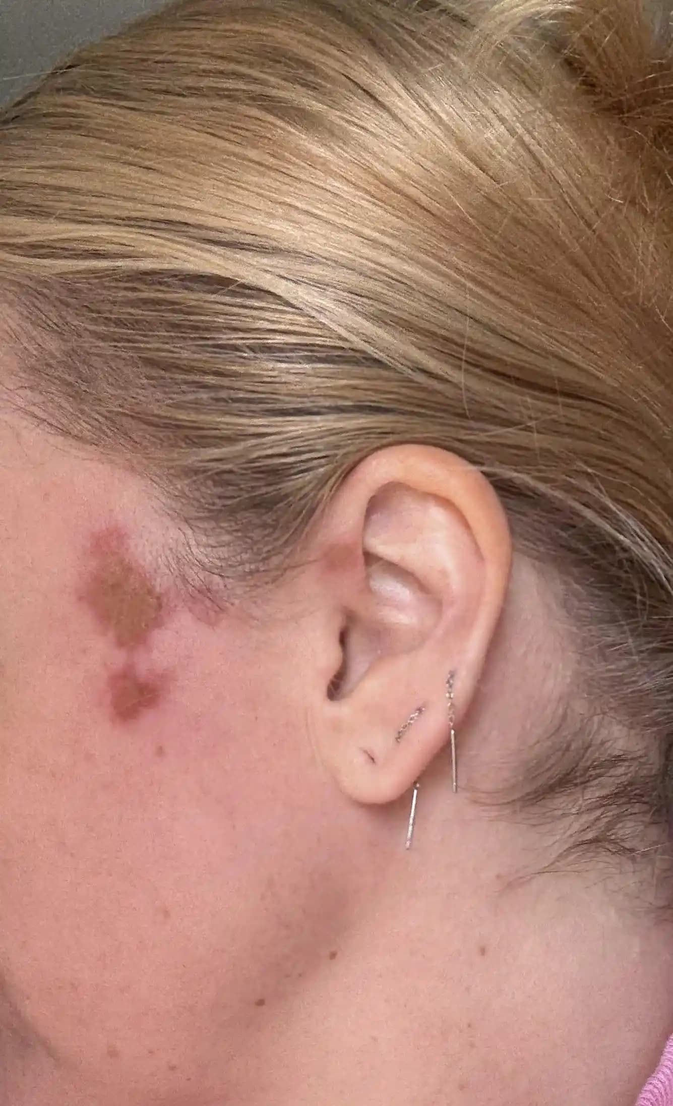 Yüz Yanıklarında İz Kalmasını Önleme ve İyileşme Süreci Yönetimi İçin Etkili Yöntemler